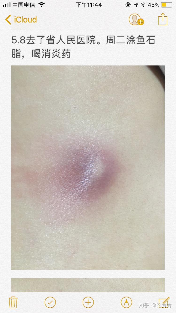 细胞癌